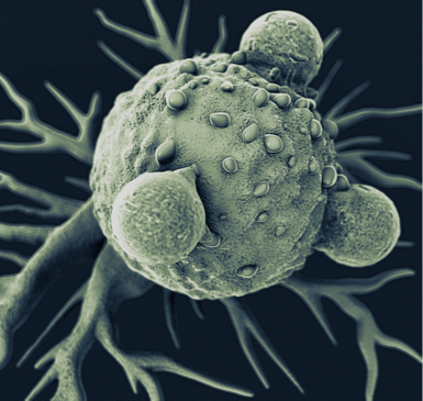 Solid Tumors